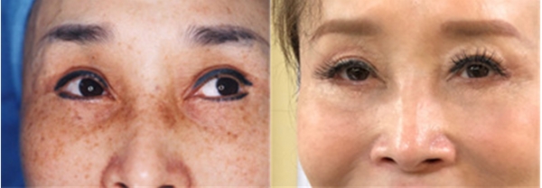 왼:20년전 제품개발초기 카츠미사장의 주근깨가 심했던 얼굴 / 사진2. 20년이 지난 현재 68세의 카츠미사장 얼굴